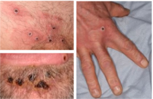 Monkeypox rash UK image 2